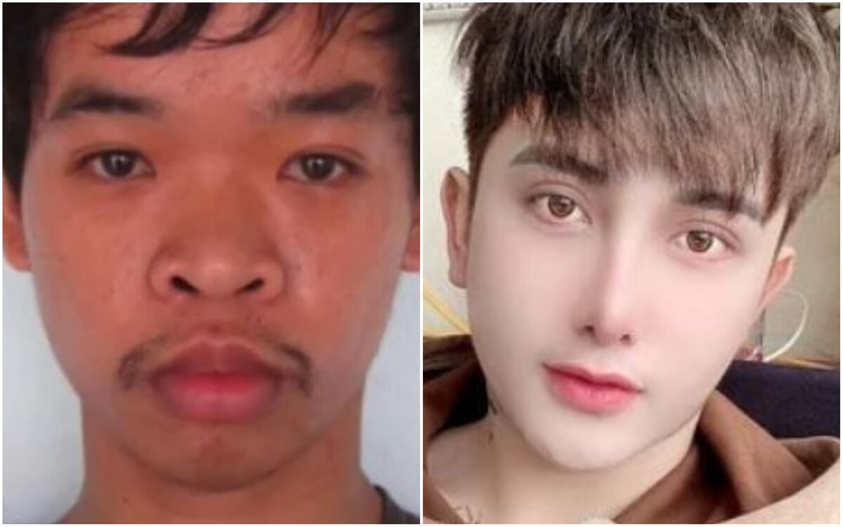 Он сделал себе ринопластику, коррекцию подбородка, а также изменил форму губ