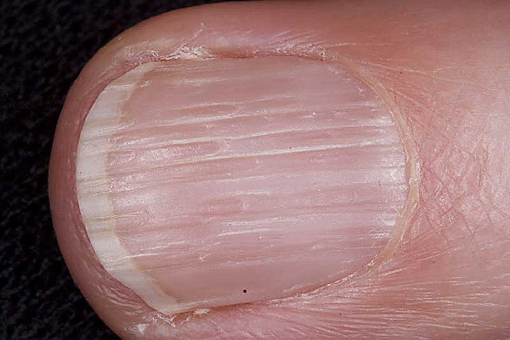Полосы на ногтях вертикальные о чем говорят. Поперечные борозды бо-Рейли. Ониходистрофия - онихолизис.. Онихорексис и онихошизис. Ониходистрофия (дистрофия ногтей).