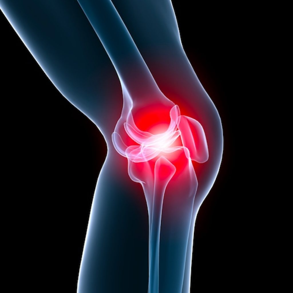 Гемартроз локтевого сустава. Артралгия тазобедренного сустава. Остеоартрит коленного сустава.
