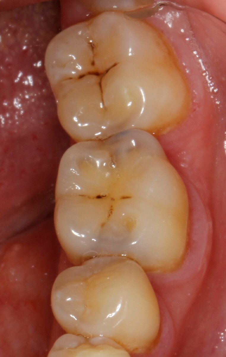 Молодой человек не жалуется на зубы, пришел на осмотр для справки перед операцией, на первый взгляд, зуб целый 