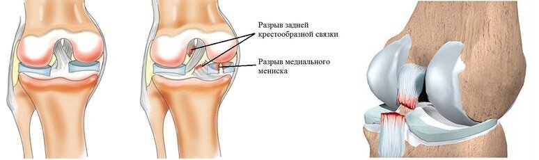 Мр картина дегенеративных изменений передней крестообразной связки