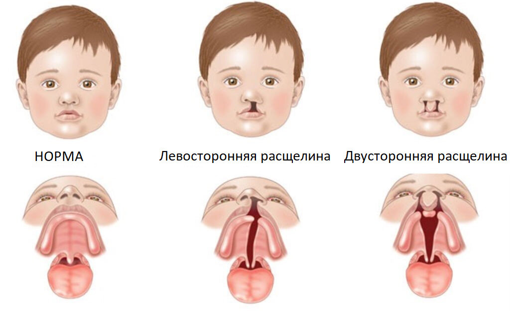 Виды расщелин при ринолалии рисунок