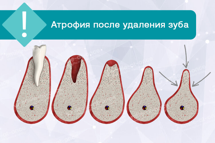 Процесс атрофии не останавливается, если зубному корню нет никакой замены. Фото: Smile-at-Once.ru.