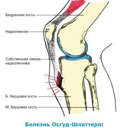Фото с сайта https://nczd.ru/bolezn-osguda-shljattera/