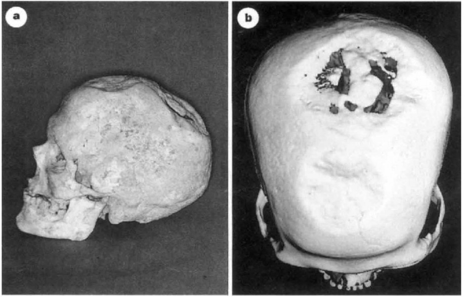 Череп с двумя трепанациями из Энсишейм, Франция. Источник: Alt, Kurt W. et al. Evidence for stone age cranial surgery // Nature, Vol. 387, 22 may 1997, p. 360.