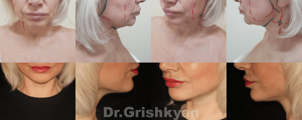 Подтяжка шеи (платизмопластика) фото до и после. Фото с сайта Д.Р. Гришкяна. Имеются противопоказания, требуется консультация специалиста