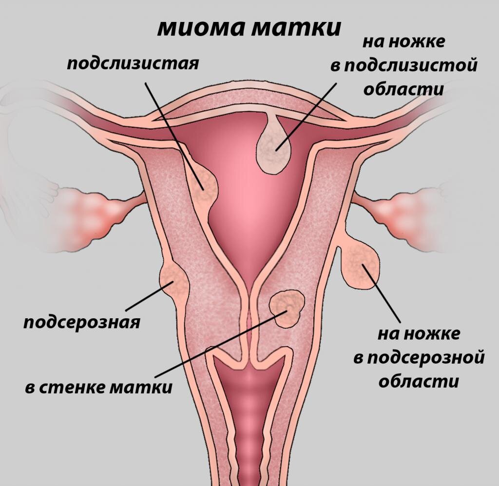 Миома матки презентация гинекология