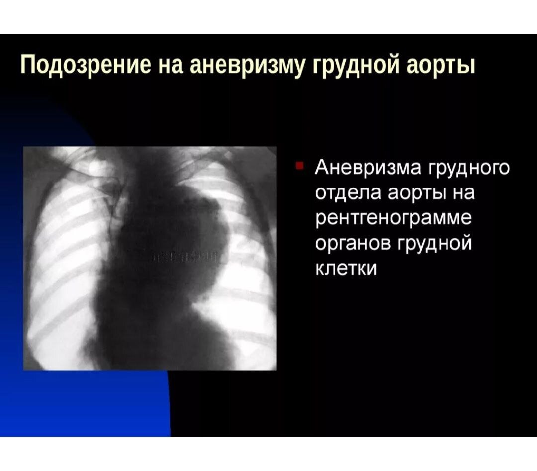 Расширение восходящей. Расслаивающая аневризма аорты рентген. Аневризма грудного отдела аорты рентген. Аневризма нисходящего отдела аорты на рентгене. Аневризма аорты сердца на рентгене.