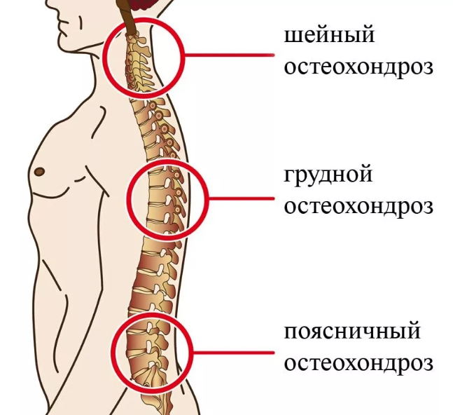 Женщины чаще страдают поражением шейного и грудного отдела, мужчины от природы имеют лучший мышечный корсет, что защищает отделы позвоночника