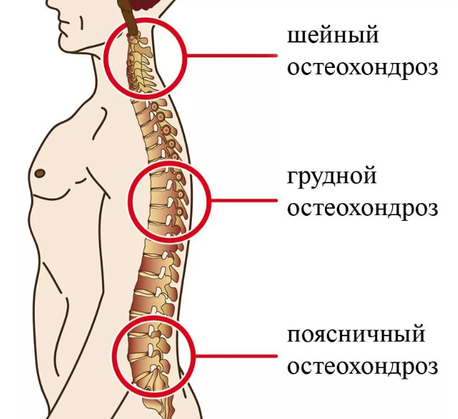 Лечение остеохондроза поясничного отдела позвоночника - статьи от компании Еламед