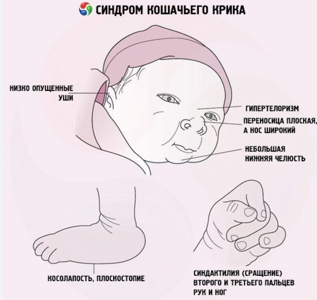 Каким номером на рисунке обозначен тип мутации характерный для больных с синдромом кошачьего крика