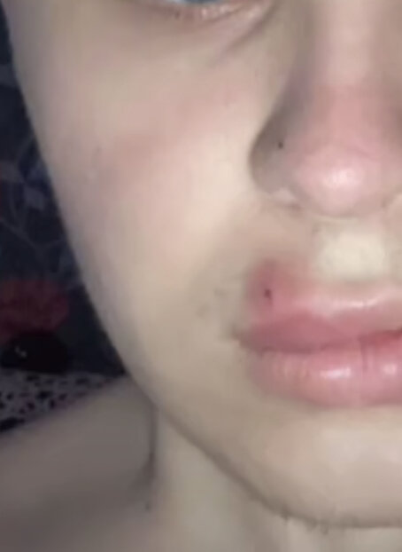 После выдавливания прыщ покраснел.