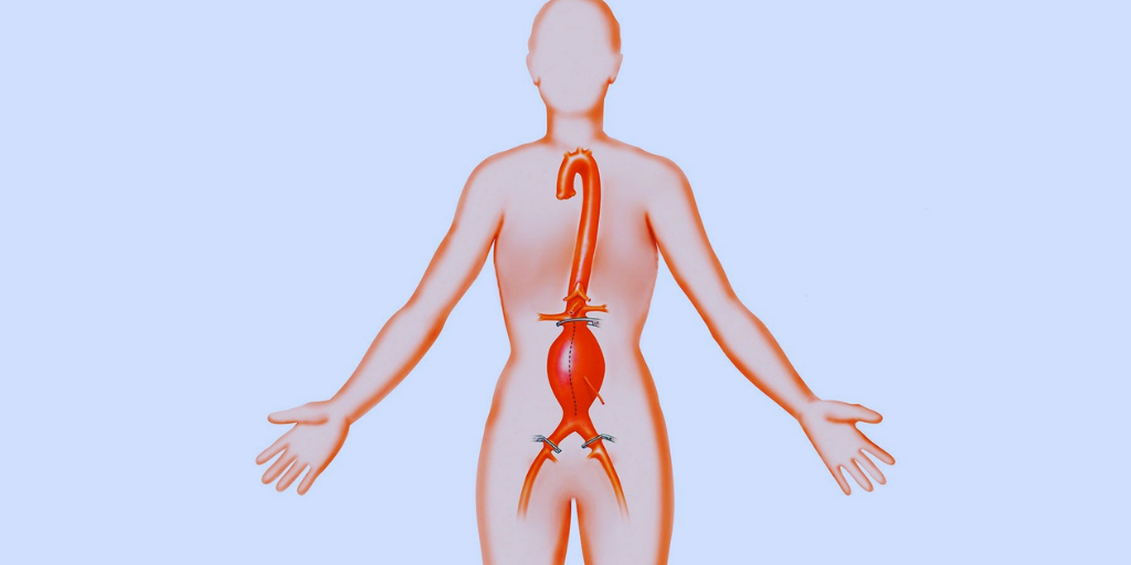 Аневризма брюшного отдела аорты.