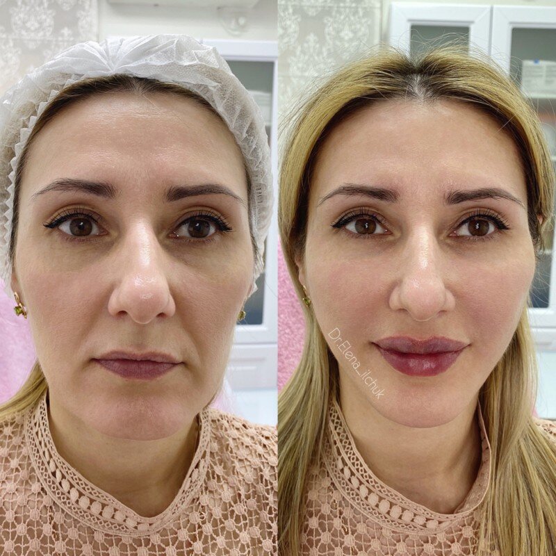 Эффект бьютификации с липофилингом