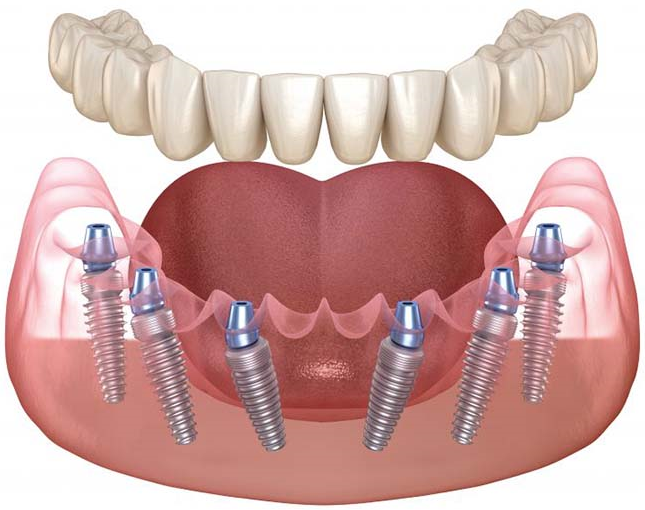 Имплантация по технологии All-on-6. Фото с сайта https://akademstom.ru/allon6