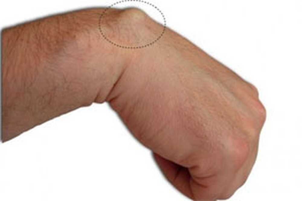 Наиболее частая локализация гигромы, при сгибании кисти ее можно лучше разгяледть. Ссылка на источник: https://clck.ru/sFj6N