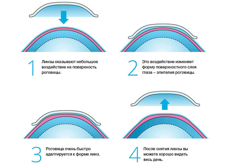 Так работают ортокератологические линзы