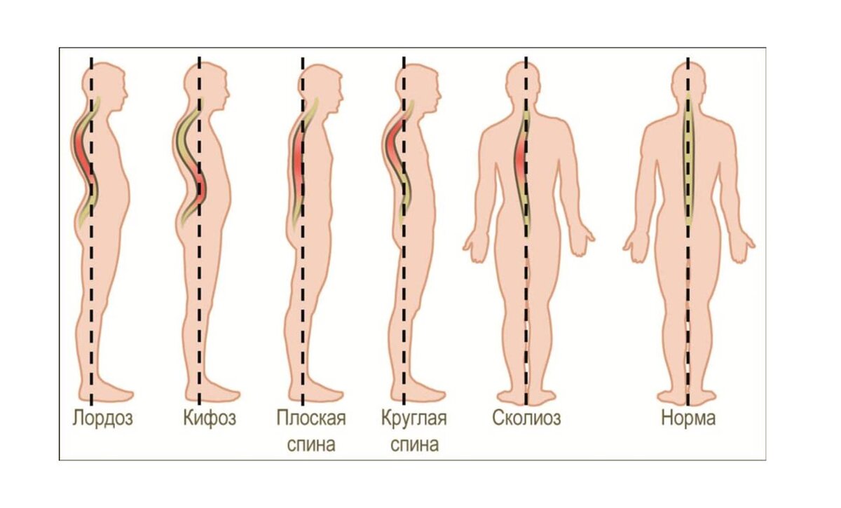 Сколиоз 1 и 2 степени. Реабилитация, лечение, симптомы, причины, диагностика | Центр Дикуля
