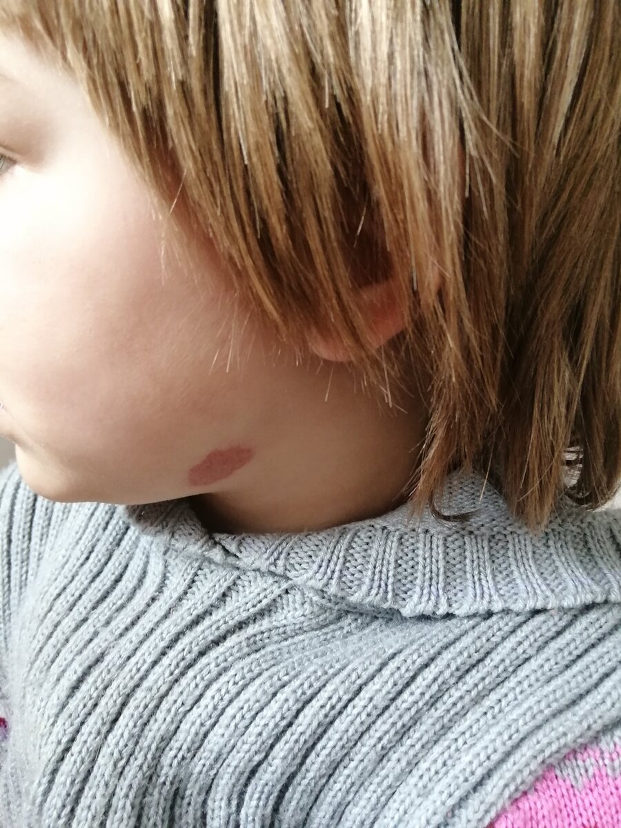 Гемангиома на подбородке. 