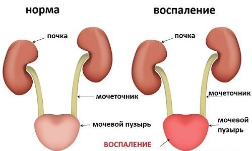 Как выглядит воспаления мочевого пузыря