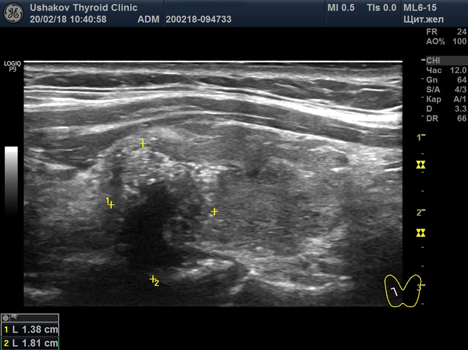 Фото узи щитовидной железы с узлом