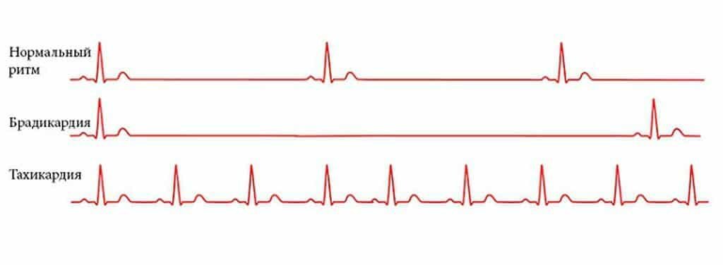 аритмия фото. пульс. брадикардия. замедленный сердечный ритм. сердце аритмия снимок.