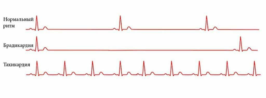 Нормальный ритм. Нормальный сердечный ритм. Замедленный сердечный ритм. Брадикардия ритм сердца. Патологическая брадикардия.