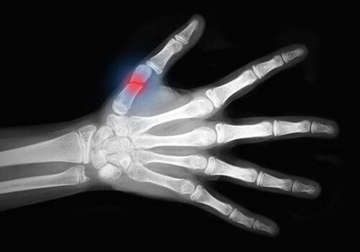 Как определить трещину в кости. Рентген переломы кисть кости. Рентген кисти вывих большого пальца. Вывих 1 пальца кисти рентген. Рентген перелом кисти мизинца.
