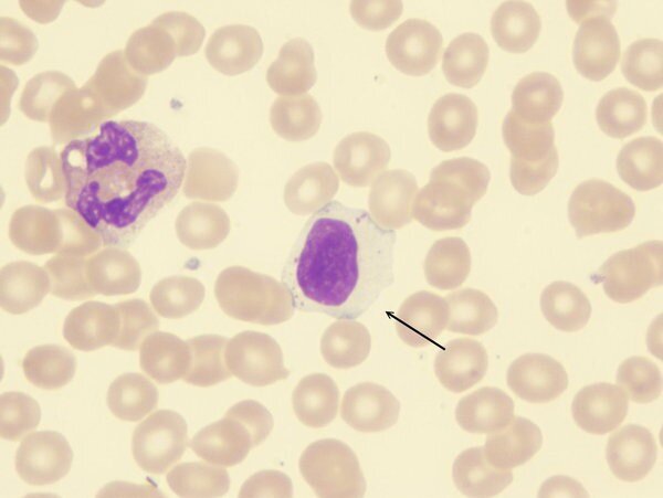 Рис. 1. В-лимфоцит среди эритроцитов. Слева - фагоцит.