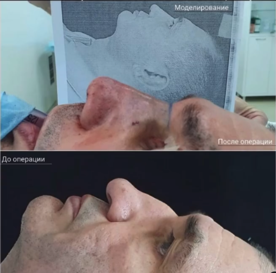 Ринопластика фото до и после. Фото предоставлено Д.Р. Гришкяном. Имеются противопоказания, требуется консультация специалиста