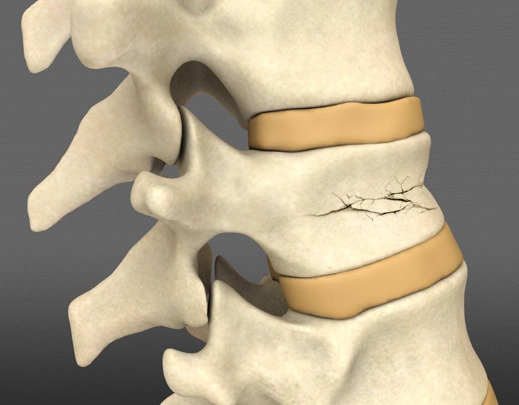 Перелом позвоночника (компресионный, осколчатый) одновременно множественные  и многоуровневые. Перелом таза, лонной кости, сидалещной кости. | Наталия  Егорова | Дзен