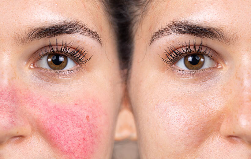 При обострении розацеа пациенты ощущают боль при прикосновениях, а также испытывают сильное жжение и зуд. С этим непросто мириться, поэтому пришла пора действовать! 