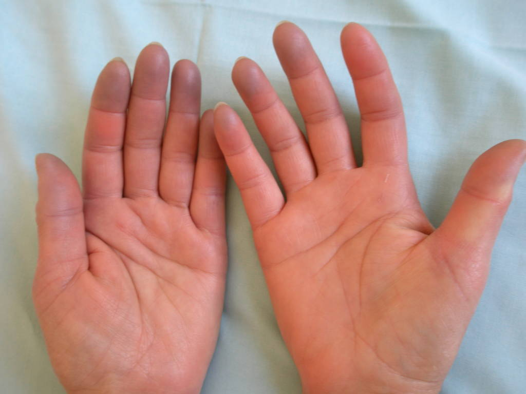 Почему синеют ногти на руках? - HTI CENTERS | Medical Tourism Center
