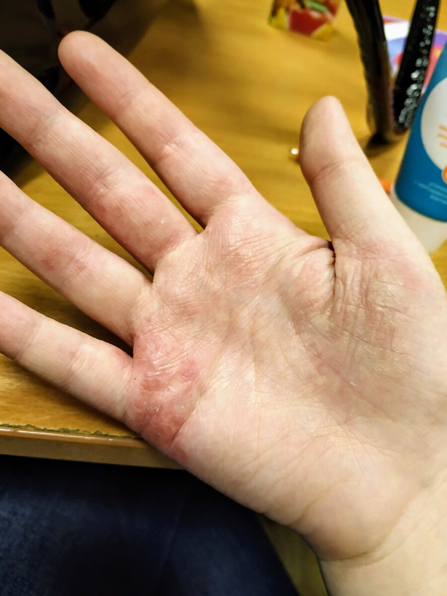 Мои руки в обычном состоянии во время аллергии