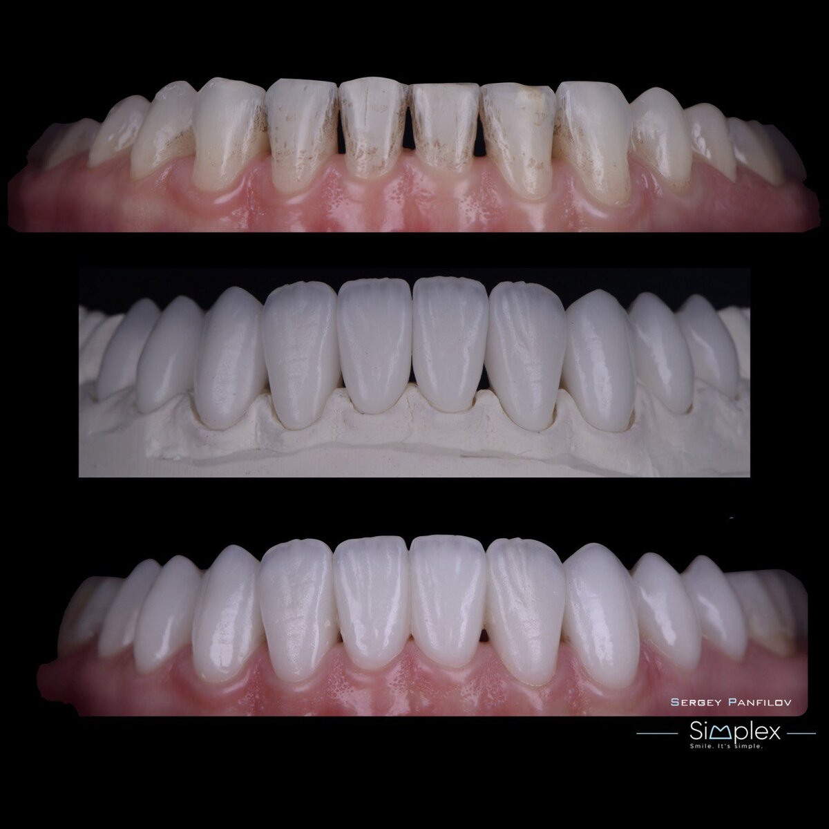 На фото – зубы пациента до установки (верхнее фото), фото виниров на гипсовой модели (в центре) и уже после переноса пациенту (нижнее фото)