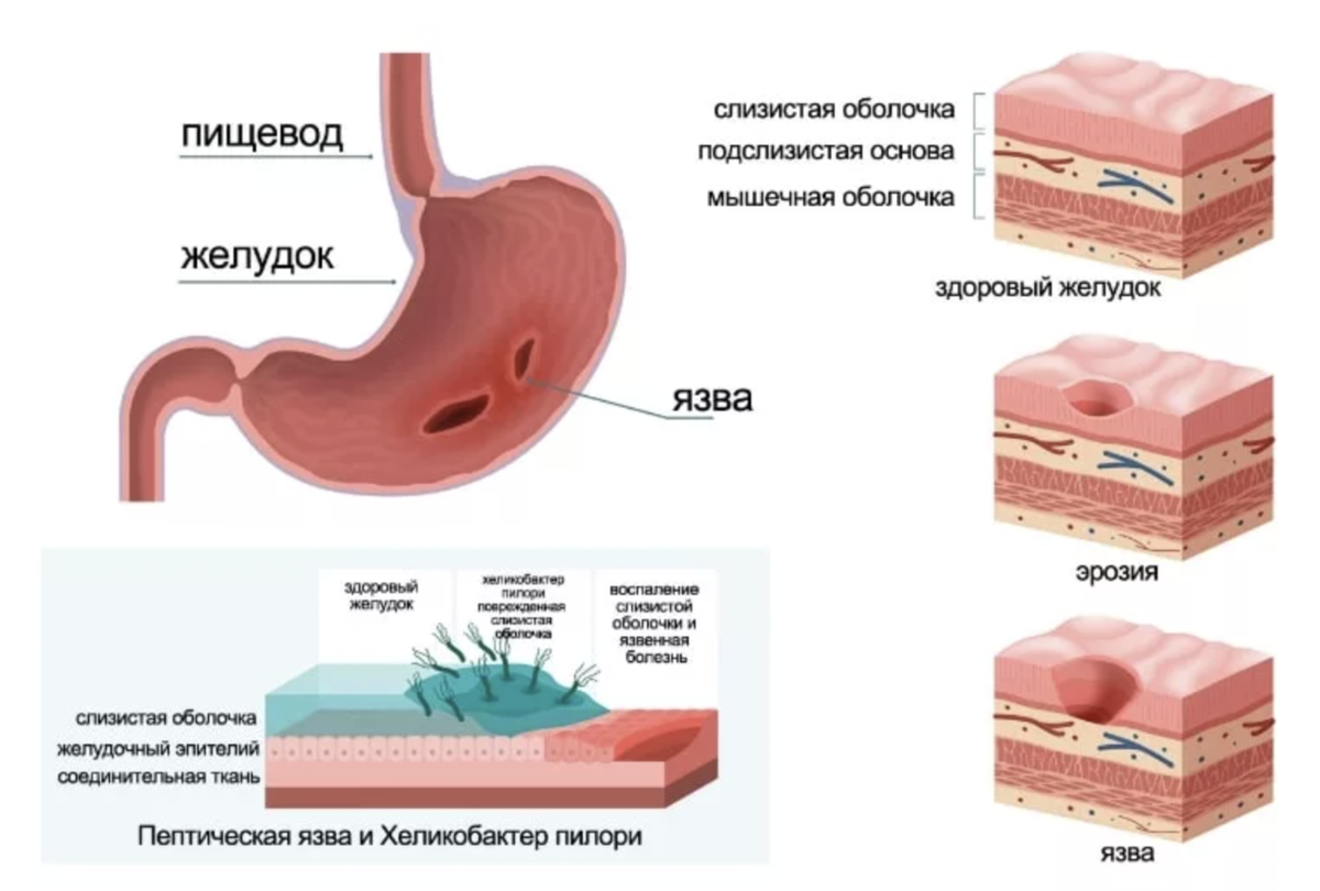 Форум боли гастрита. Язвенная болезнь желудка ,эпителизация. Язвенная болезнь желудка форма поражения. Язвенная болезнь желудка -стадии формирования язвы.