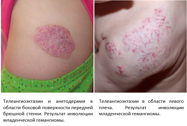 Иллюстрации из книги "Гемангиома" , автор Романов Д.В. 2022