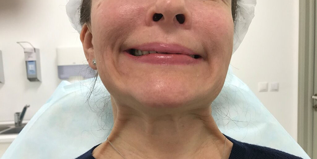 Лицевой нерв, фото с сайта хирурга Д.Р.Гришкяна, имеются противопоказания, требуется консультация специалиста. 