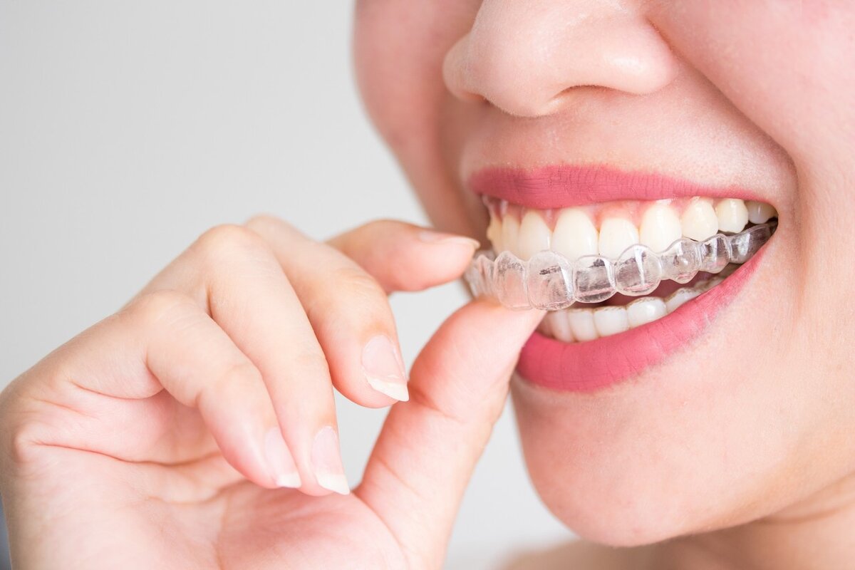 Брекеты дорого. Ортодонт каппы элайнеры. Элайнеры Invisalign. Невидимые брекеты элайнеры. 3d smile элайнеры.