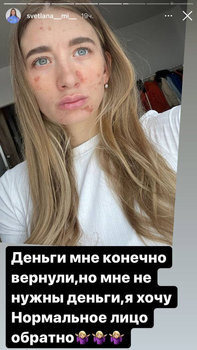 Российская биатлонистка Светлана Миронова сообщила в социальных сетях, что косметолог повредил ей кожу лица.  — В общем на приеме у косметолога, видимо, что-то пошло не так, и мне сожгли лицо.-2