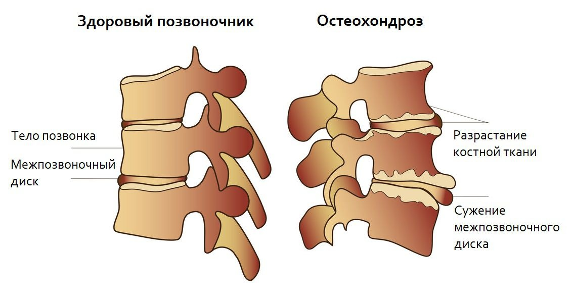 Остеохондроз поясничного отдела позвоночника периоды. Остеохондроз поясничного отдела позвоночника. Межпозвонковый остеохондроз поясничного отдела позвоночника. Остеохондроз 2 степени межпозвоночных дисков грудного отдела. Остеохондроз грудного и поясничного отделов позвоночника.