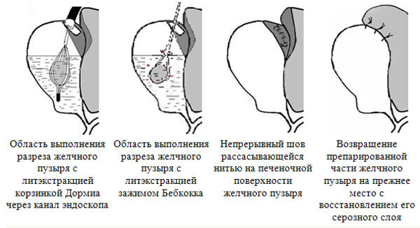 операция по удалению камней с сохранением желного пузыря