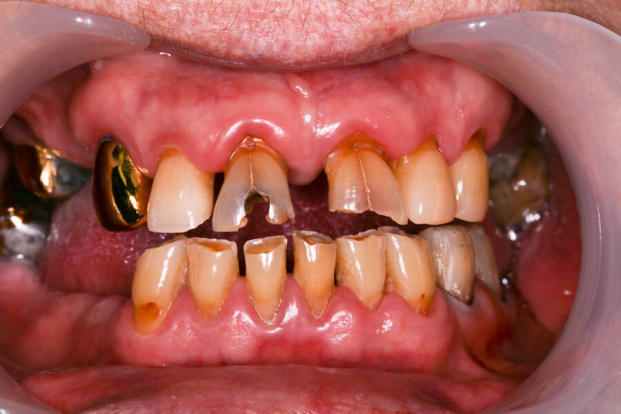 Стертые зубы у пожилых пациентов без должного ухода - доктора стоматологии Холидент рекомендуют профилактические приемы у стоматологов, чтобы избежать крайних случаев