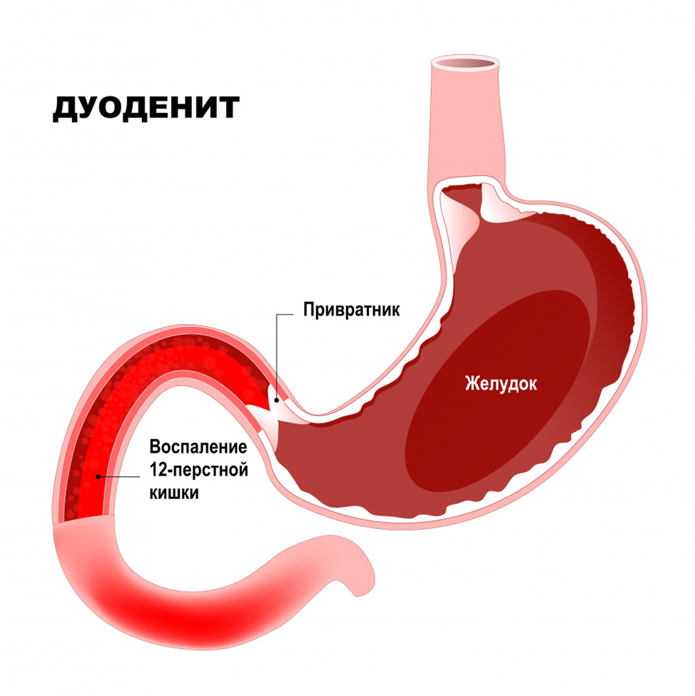 Дуоденит. Лечение народными средствами