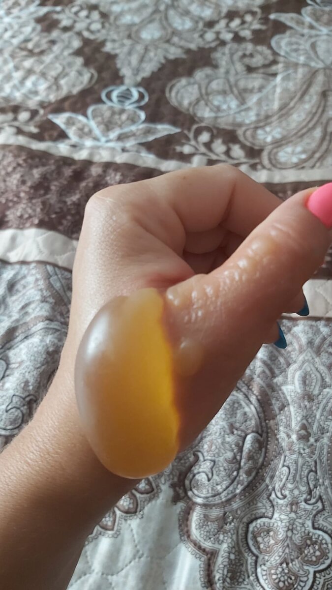 Вот такие страшные ожоги