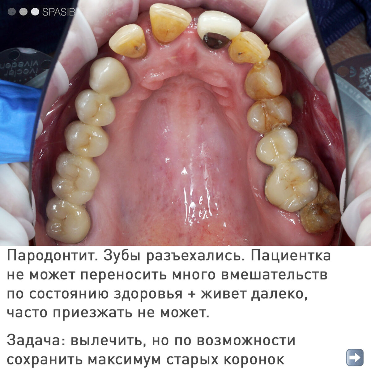 ПАРОДОНТИТ: ВОССТАНОВЛЕНИЕ | Спасибо.Клиник | Дзен