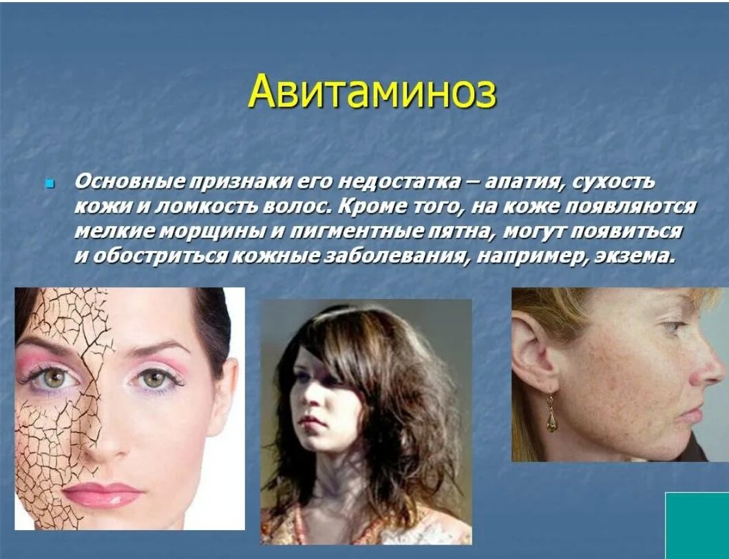 Авитаминоз. Витаминос. Проявление авитаминоза. Симпеталы аветоминоза.