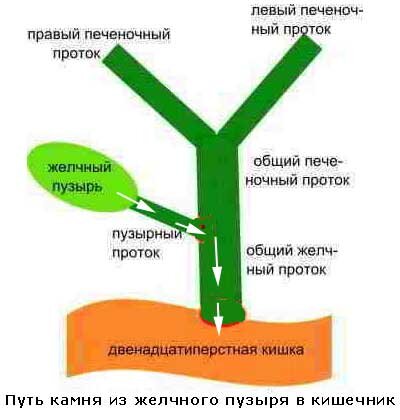 Передвижение камня от желчного пузыря к двенадцатиперстной кишке, когда возникает болевой приступ при желчекаменной болезни.