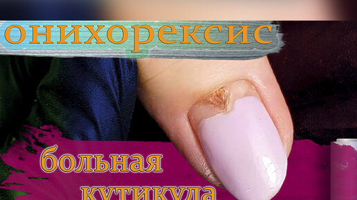 Онихорексис больная кутикула ногтя | Надежда Ромодина | Дзен