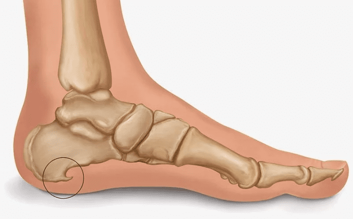 Пяточная шпора симптомы и лечение